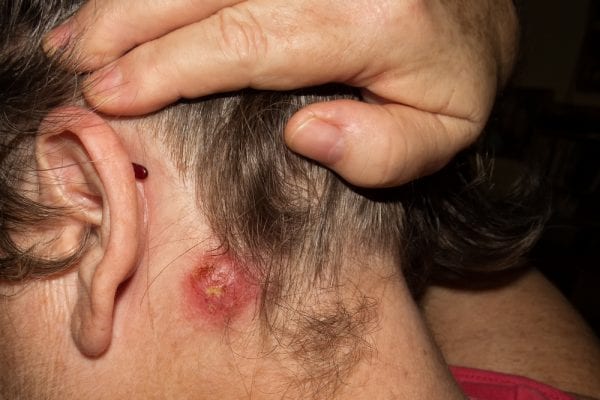Woman with staph infection symptoms